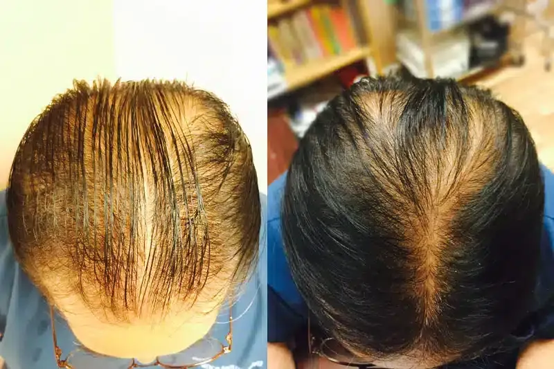 Before and after patient treatment result at Vita Sana Medical Center
