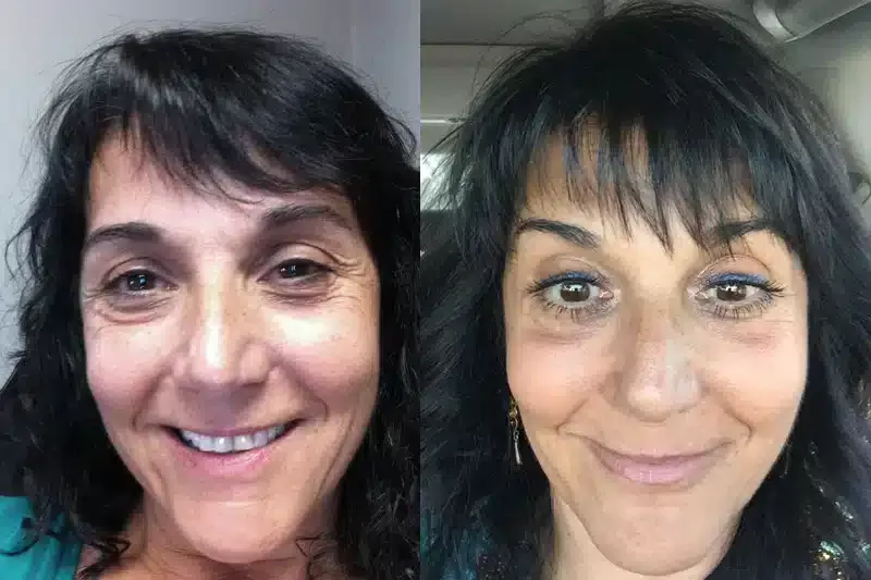 Before and after patient treatment result at Vita Sana Medical Center