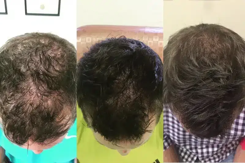 Before and after patient treatment result at Vita Sana Medical Center
