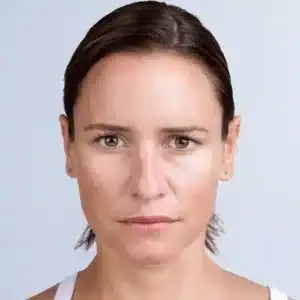 Anna two weeks after Xeomin treatment