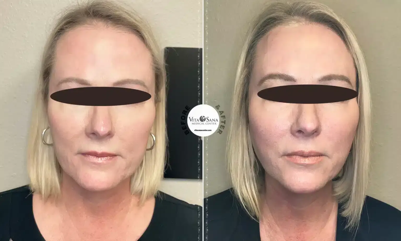 Before and after patient treatment result at Vita Sana Medical Center