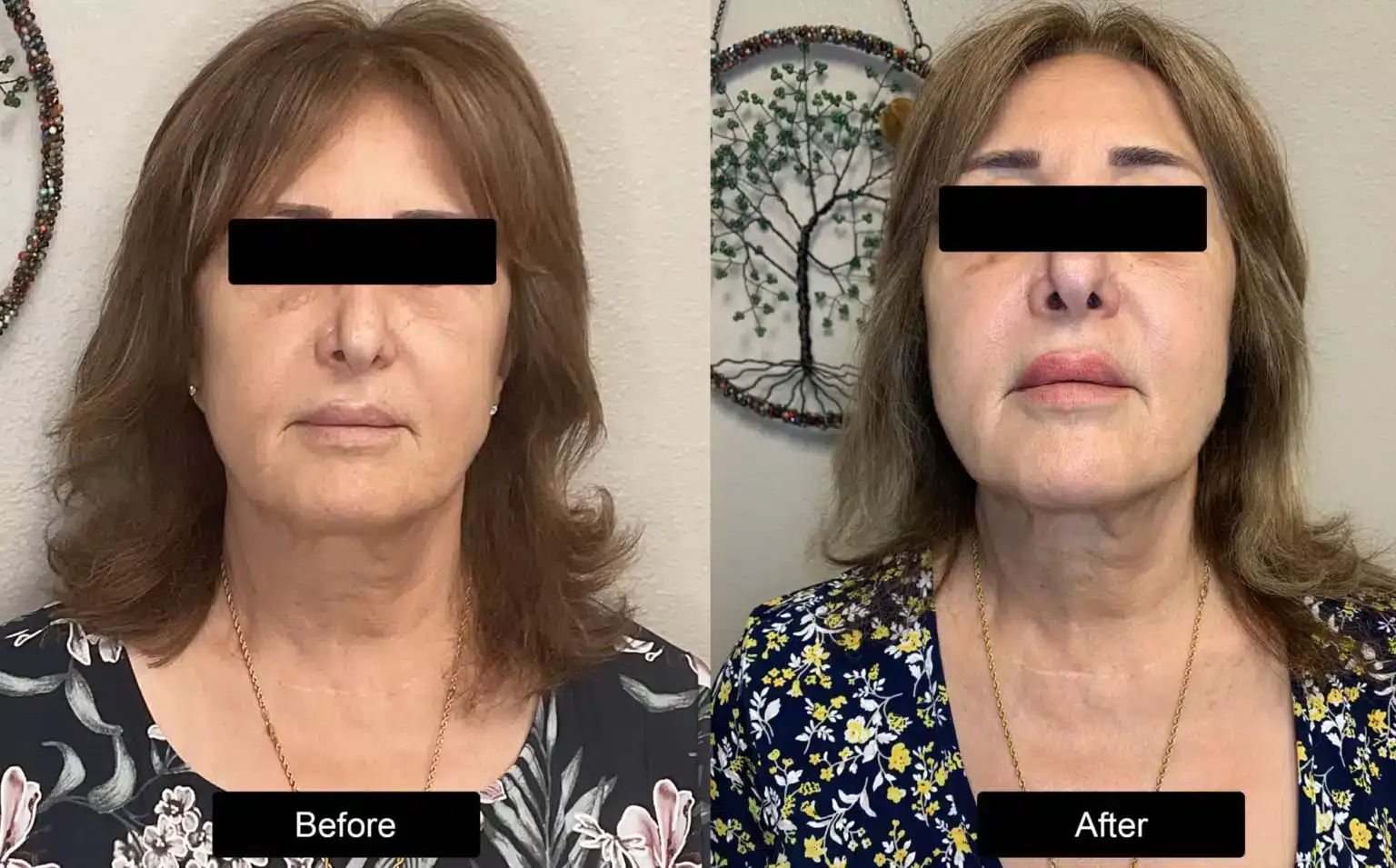 Before and after patient treatment result at Vita Sana Medical Center