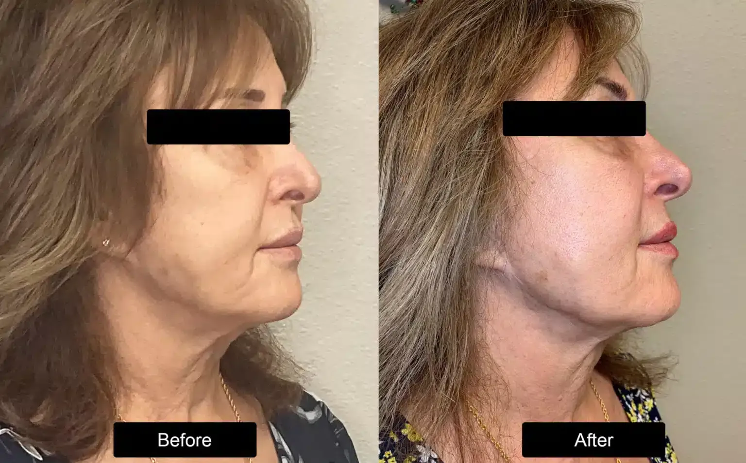 Before and after patient treatment result at Vita Sana Medical Center