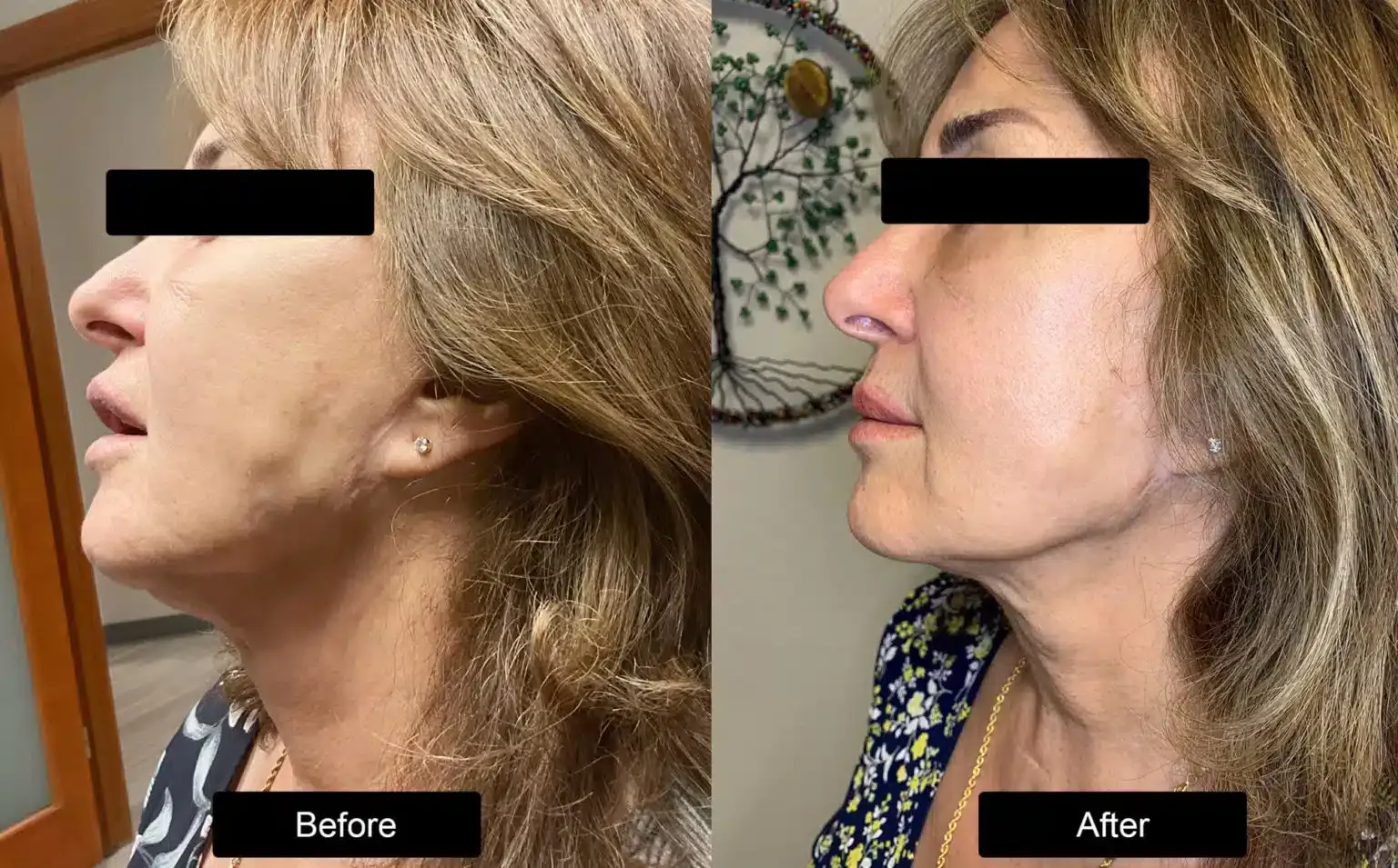 Before and after patient treatment result at Vita Sana Medical Center
