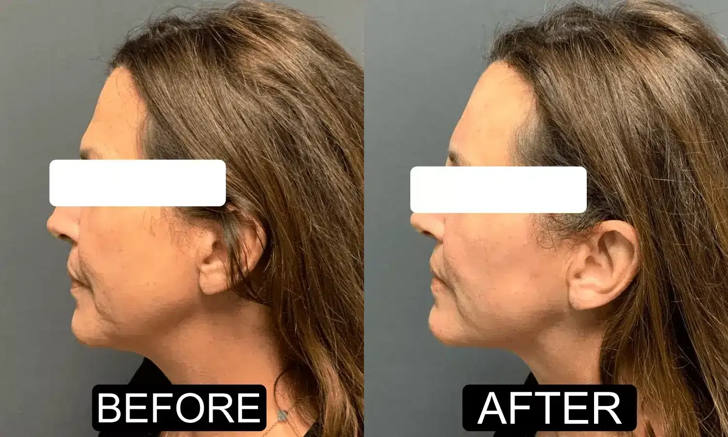 Before and after patient treatment result at Vita Sana Medical Center