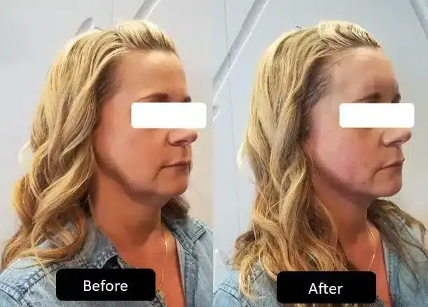 Before and after patient treatment result at Vita Sana Medical Center